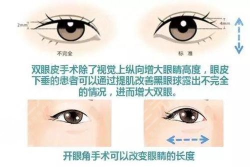 開眼角和不開眼角的原因