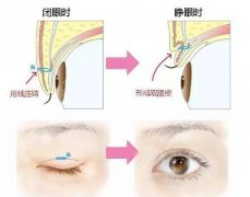 埋線雙眼皮恢復(fù)時(shí)間長(zhǎng)嗎？恢復(fù)期間照片丑嗎？