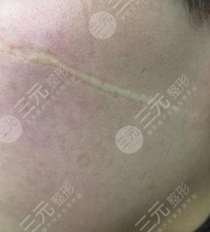 遵義醫(yī)學(xué)院附屬醫(yī)院整形祛疤案例