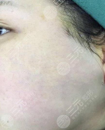 遵義醫(yī)學(xué)院附屬醫(yī)院整形祛疤案例