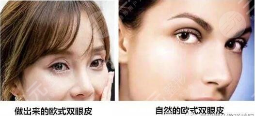 歐式全切雙眼皮可以修復(fù)嗎