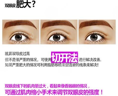 歐式全切雙眼皮怎么修復(fù)