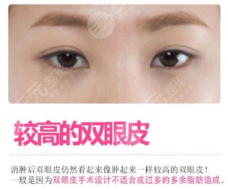 歐式全切雙眼皮怎么修復(fù)
