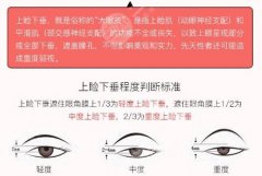 上眼皮松弛矯正術(shù)價(jià)格|后遺癥|恢復(fù)圖片