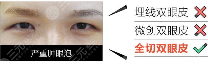 雙眼皮全切影響價格的因素