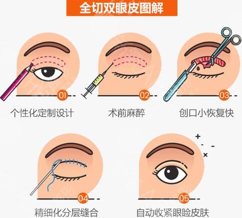 雙眼皮全切手術(shù)多長時間