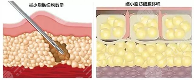 面部吸脂溶脂方法