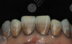 四環(huán)素牙齒能美白嗎？能治嗎？注意事項(xiàng)