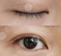 雙眼皮埋線可以拆掉嗎？埋線后悔了怎么辦？
