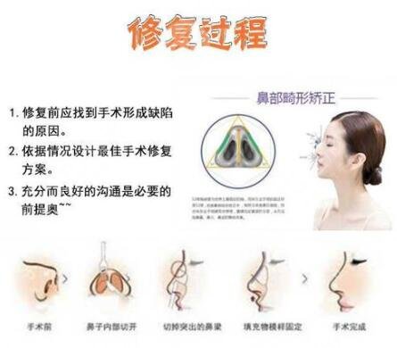 鼻修復(fù)是什么