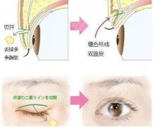 切雙眼皮全過程，肉條要多久才能消失？