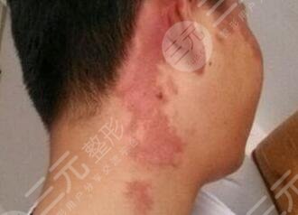 去除胎記后的護理