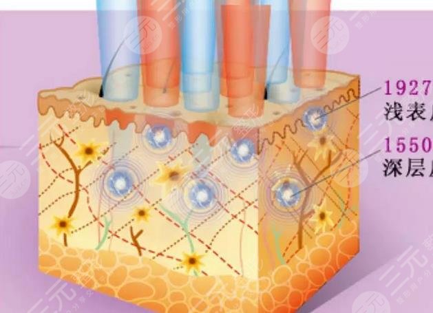飛梭鐳射和點陣激光哪個好