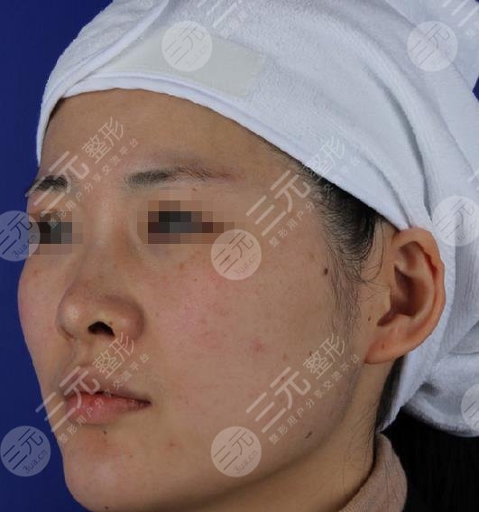 光子嫩膚果對(duì)比照片