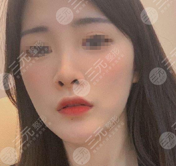 光子嫩膚果對(duì)比照片