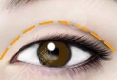 雙眼皮8mm恢復(fù)自然后有多寬？這篇科普教你如何get美麗電眼！