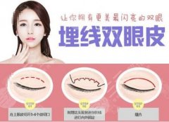 埋線雙眼皮維持多久？適合哪些人？美眼小秘籍分享！
