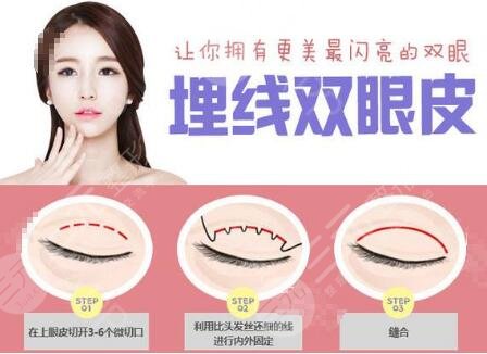 埋線雙眼皮維持多久