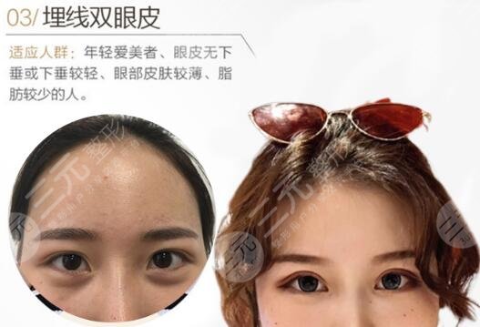 埋線雙眼皮維持多久