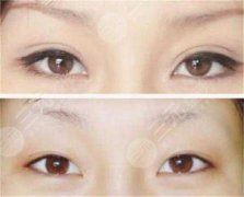 雙眼皮翹睫術(shù)前后圖片：真人體驗(yàn)雙眼皮翹睫果~