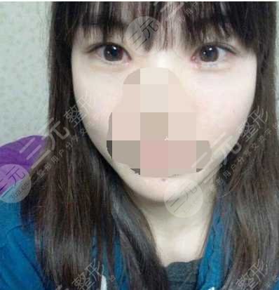 術(shù)后的一個月