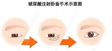 玻尿酸填充臥蠶示意圖