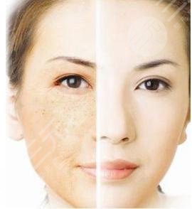 光子嫩膚原理