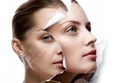 光子嫩膚注意事項