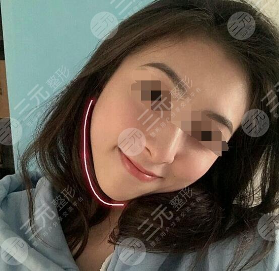 真人體驗(yàn)注射瘦臉注射后一個(gè)月