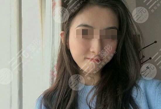 真人體驗(yàn)注射瘦臉注射后2個(gè)月