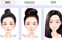 高分子埋線雙眼皮是什么？?jī)?yōu)缺點(diǎn)解析+果圖分享，必看攻略！