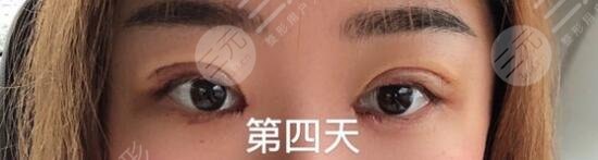 術(shù)后的一周