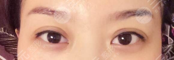 生物焊接雙眼皮的真相，生物焊接雙眼皮是什么原理？