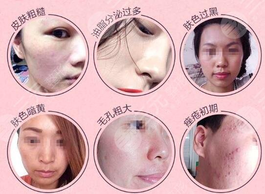 黑臉娃娃項(xiàng)目后需要注意的事項(xiàng)