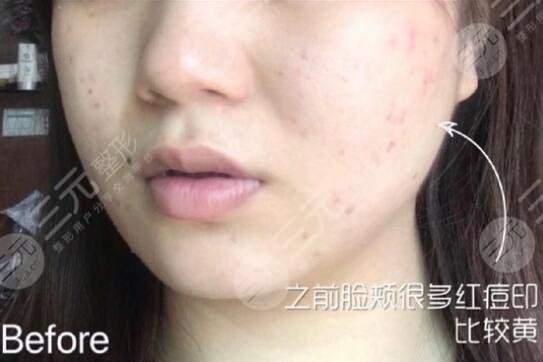 黑臉娃娃嫩膚體驗前