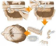 植發(fā)手術(shù)需要多少費用？術(shù)前準(zhǔn)備及術(shù)后注意事項大全~