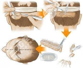 植發(fā)手術需要多少費用