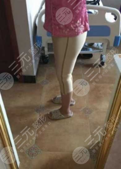 煙臺山醫(yī)院張文安吸脂后一個月