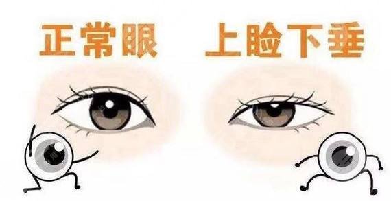 眼瞼下垂怎么自己糾正