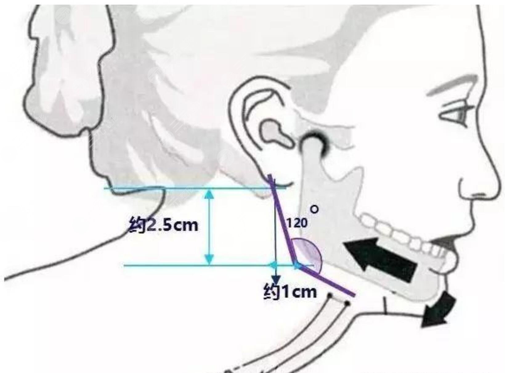 磨骨整容手術(shù)