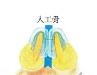 人工骨隆鼻吸收率
