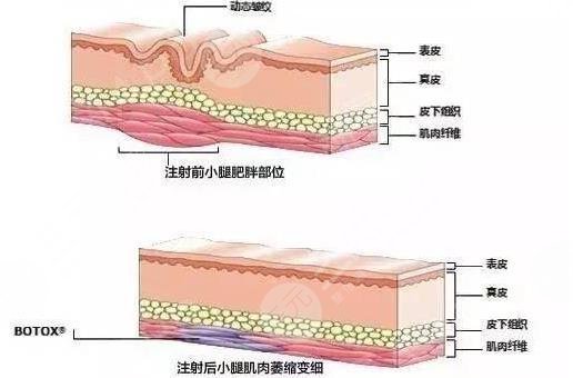 注射瘦腿?的價格與產品質量有關