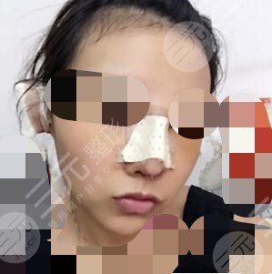 隆鼻前后對比果圖片