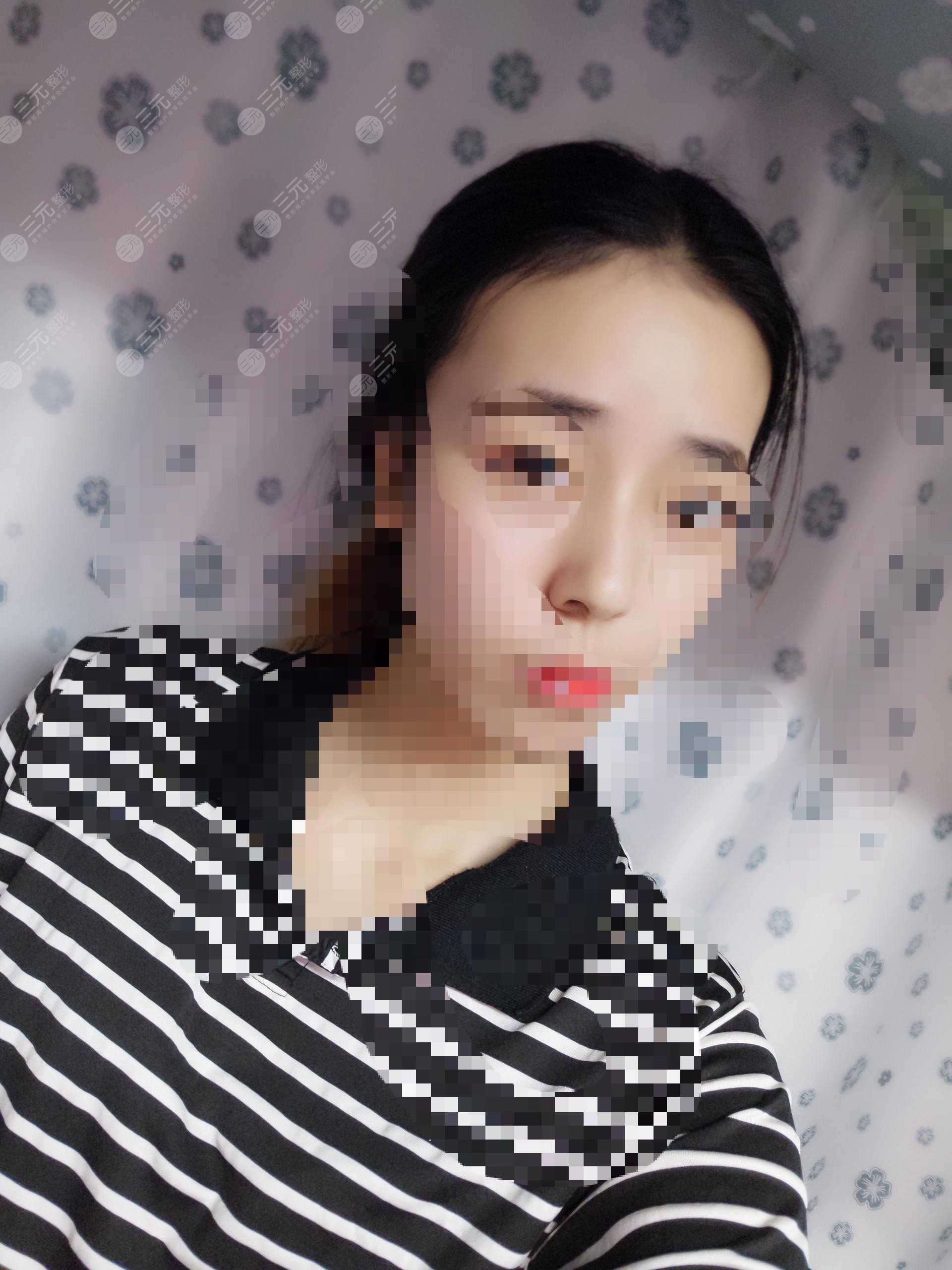 隆鼻前后對比果圖片