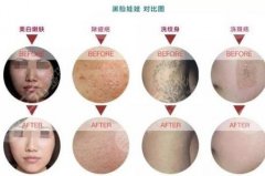 黑臉娃娃嫩膚疼嗎？黑臉娃娃嫩膚后注意哪些?