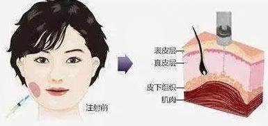 注射瘦臉的原理