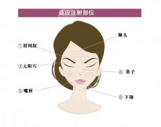 注射填充去皺成好嗎？原理科普+果圖一覽！