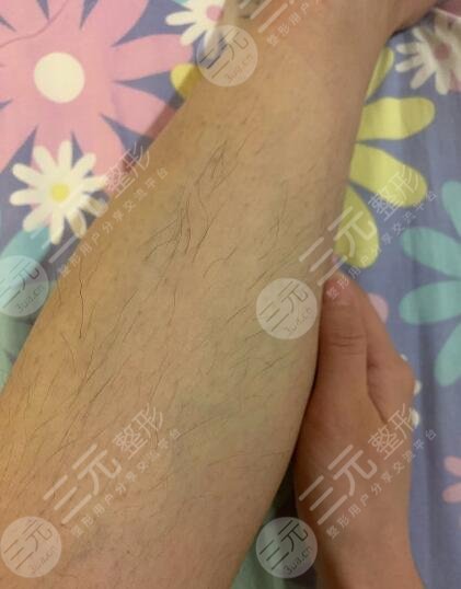 泰州市人民醫(yī)院脫毛價(jià)格貴嗎？如果你有嚴(yán)重汗毛煩惱一定不要錯(cuò)過！