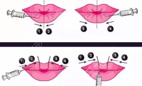 非手術豐唇方法有哪些