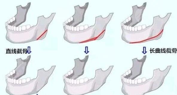 磨骨手術(shù)術(shù)后注意事項(xiàng)